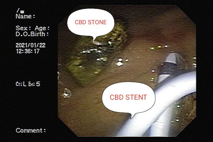 Mechanical lithotripsy for large CBD stone