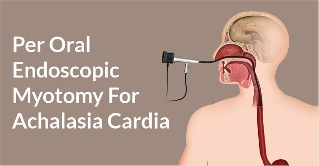 Peroral Endoscopic Myotomy for Achalasia Cardia