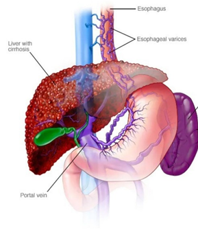 What is the Primary Cause of Esophageal Varices