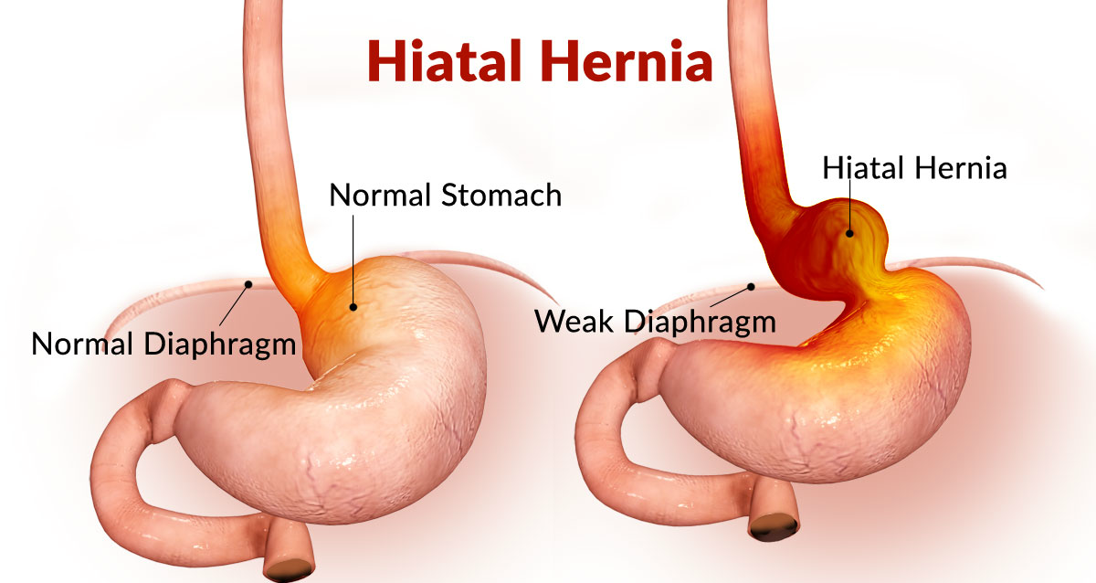 what-are-some-hernia-symptoms-with-pictures