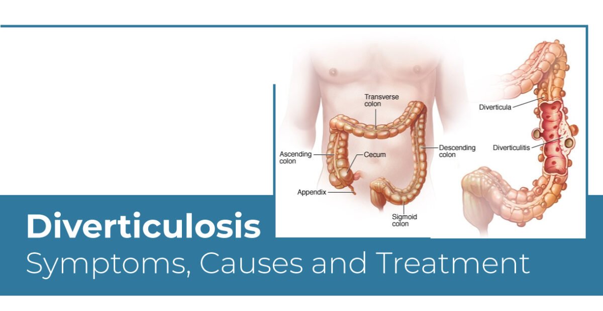 Diverticulosis Symptoms, Causes and Treatment
