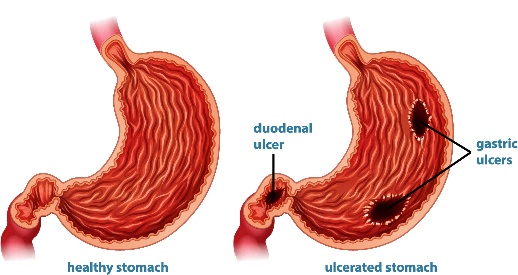 Peptic ulcers often develop due to bacteria infection