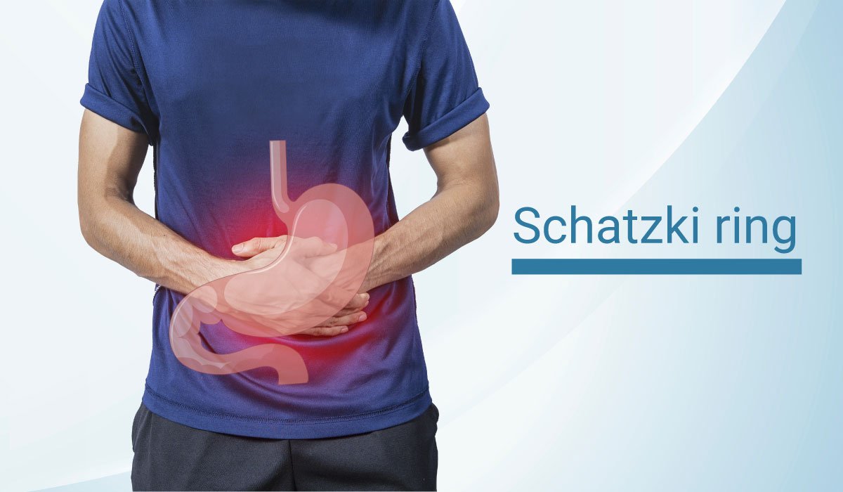 Schatzki Ring – Symptoms, Cause, Diagnosis & Treatment