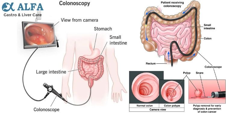 colonoscopy - before, during, and after