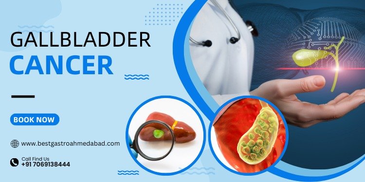 Understanding Gallbladder Cancer Symptoms, Diagnosis, and Treatment