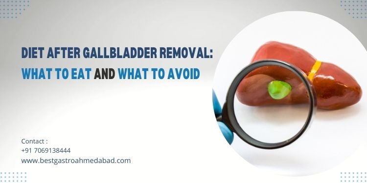 Diet After Gallbladder Removal What to Eat and What to Avoid
