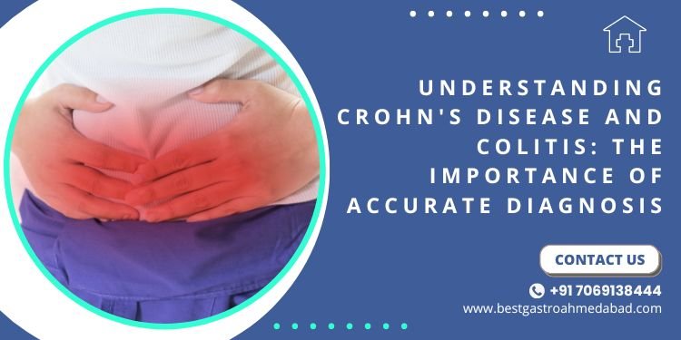 Crohn’s Disease vs. Colitis: How to Ensure the Right Diagnosis