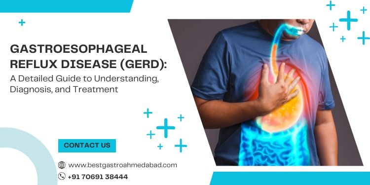 Gastroesophageal Reflux Disease (GERD) A Detailed Guide to Understanding, Diagnosis, and Treatment