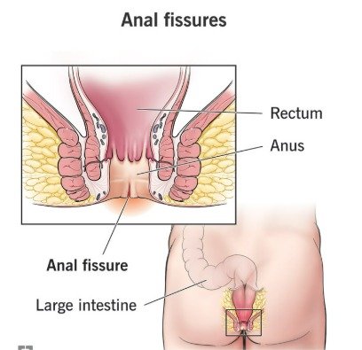 Anal Fissure
