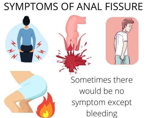 Anal Fissure