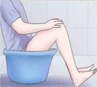 Anal Fissure
