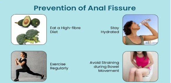Anal Fissure
