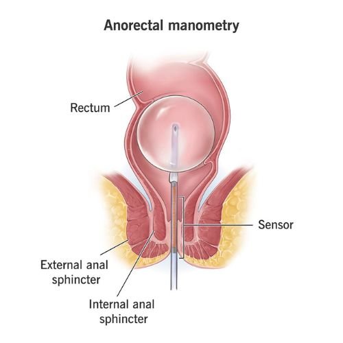 Anorectal Manometry (ARM) Test