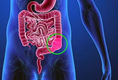 constipation pain