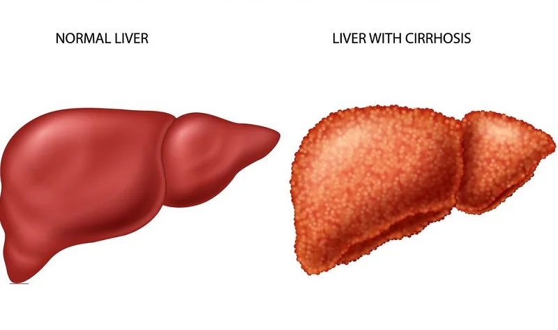 What is Cirrhosis of the Liver? Symptoms and Causes