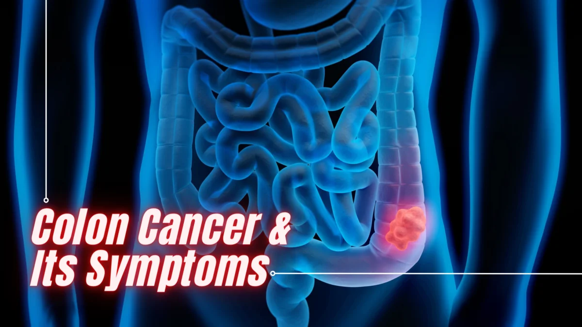 Colon Cancer and Its Symptoms